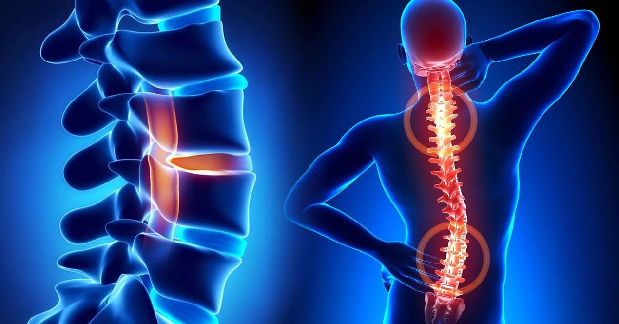 complicaciones de la osteocondrosis cervical