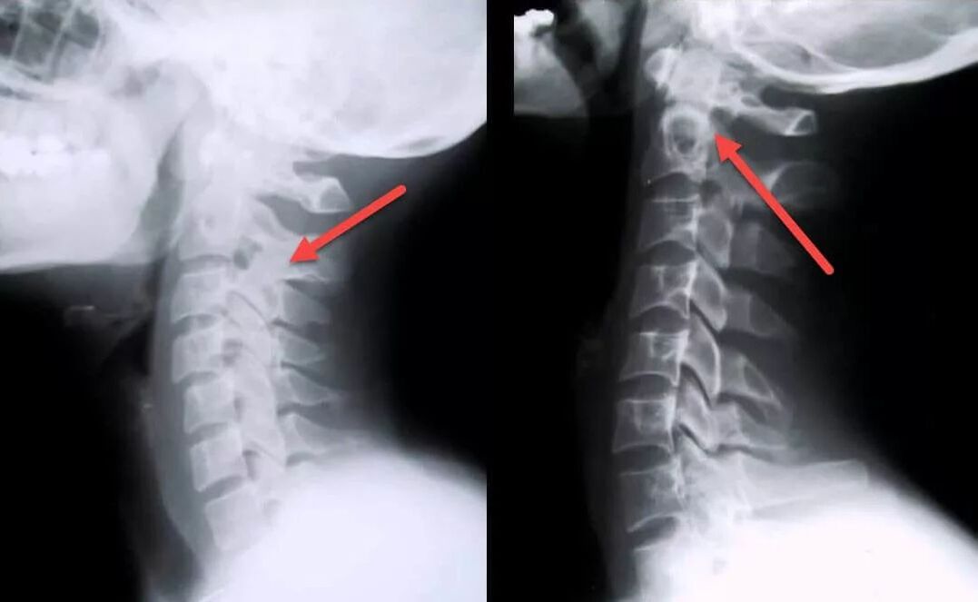 diagnóstico de osteocondrosis cervical