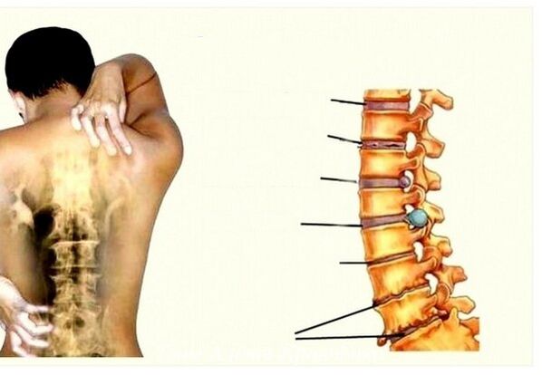Etapas de la osteocondrosis cervical