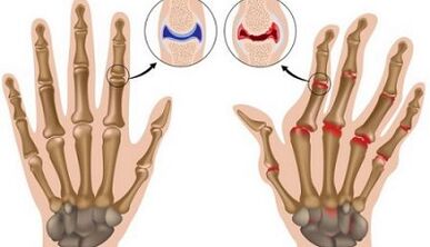 Las principales diferencias de artritis y artrosis