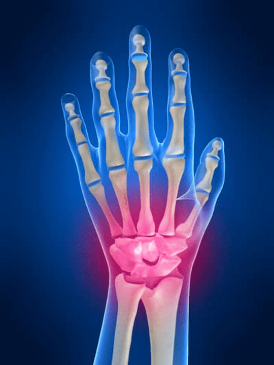 Artritis de la articulación