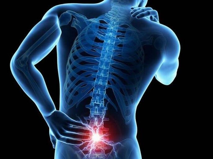 Con la radiculitis, las raíces nerviosas pellizcadas provocan la aparición de un dolor agudo en la zona lumbar.