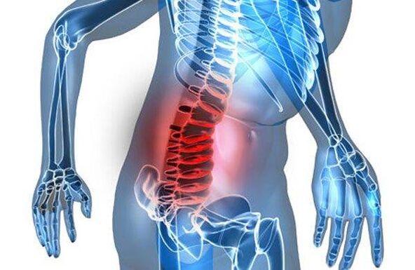 Deformidad de la columna en la cuarta etapa de la osteocondrosis lumbar.