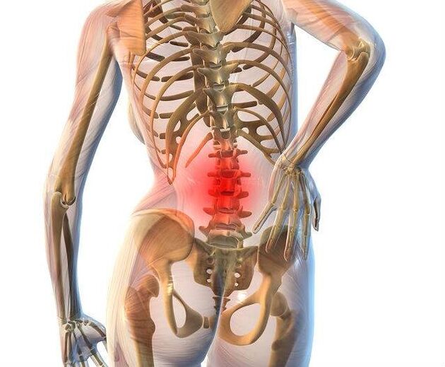 Osteocondrosis de la columna lumbar.