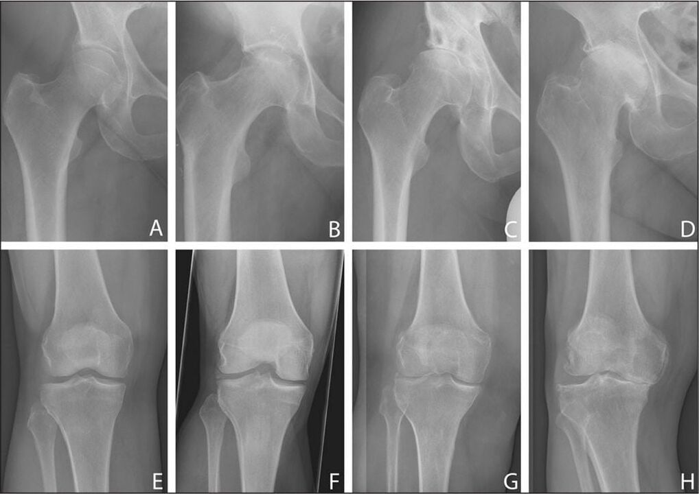 Etapas de desarrollo de artrosis articular en una radiografía.