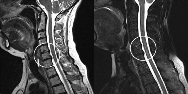 Resonancia magnética de la columna cervical con signos de osteocondrosis.